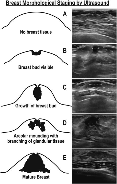 nude budding breasts|Normal Breast Development